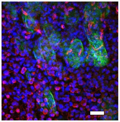 Image of colorectal cancer cells (green) and primary fibroblasts (red) at the border between malignant cells and stroma
